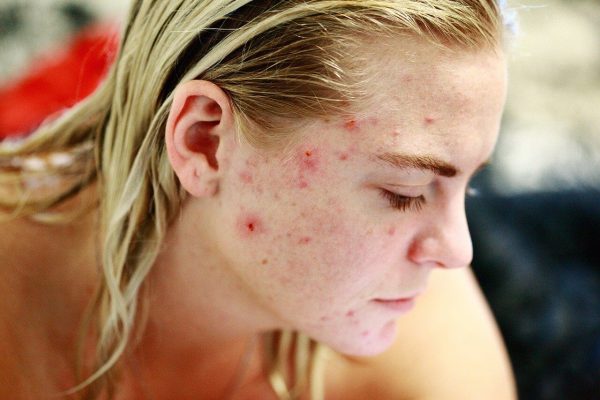 تخم‌مرغ صنعتی و تشدید آلرژی‌ پوستی؛ مضرات مصرف محصولات حیوانی، منابع جایگزین سالم
