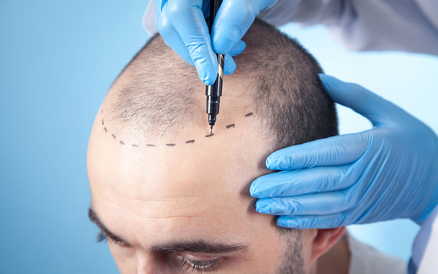 بهترین دکتر کاشت مو در کاشان