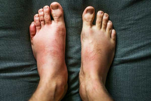 رژیم غذایی حیوانی و بیماری‌های مزمن التهابی؛ مسیر به سوی سلامت گیاهی