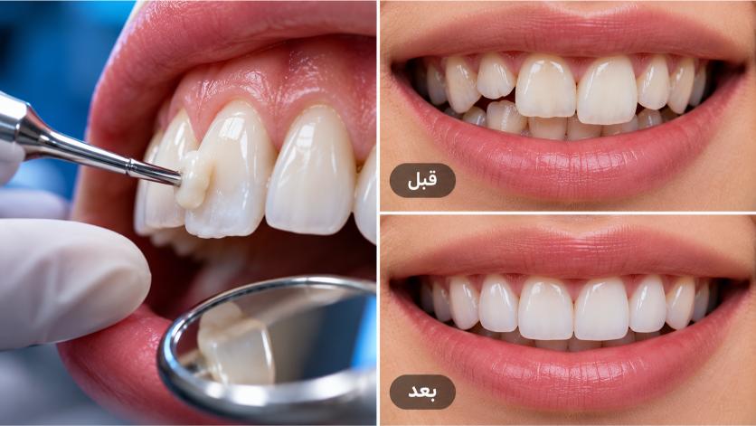 کامپوزیت دندان کج یعنی چه؟